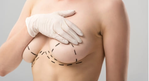 Breast Uplift