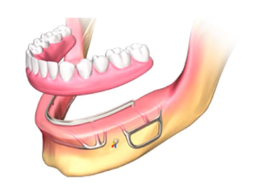 Subperiosteal dental Implants