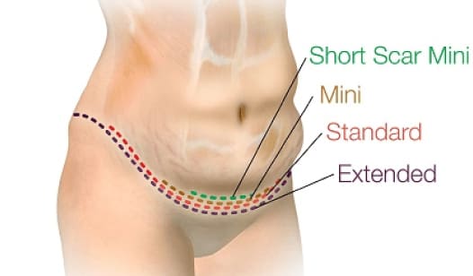 types of abdominoplasty turkey