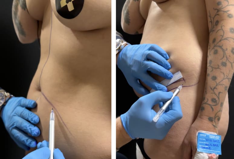 Tummy Tuck procedure