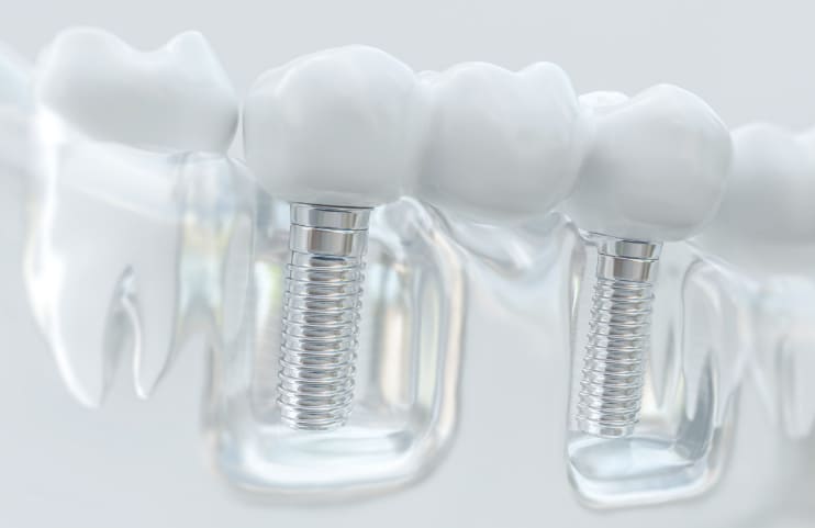 Full set of dental implants Turkey