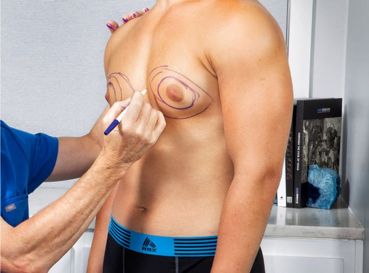 Gynecomastia Turkey 1 what is 1 Gynecomastia Turkey