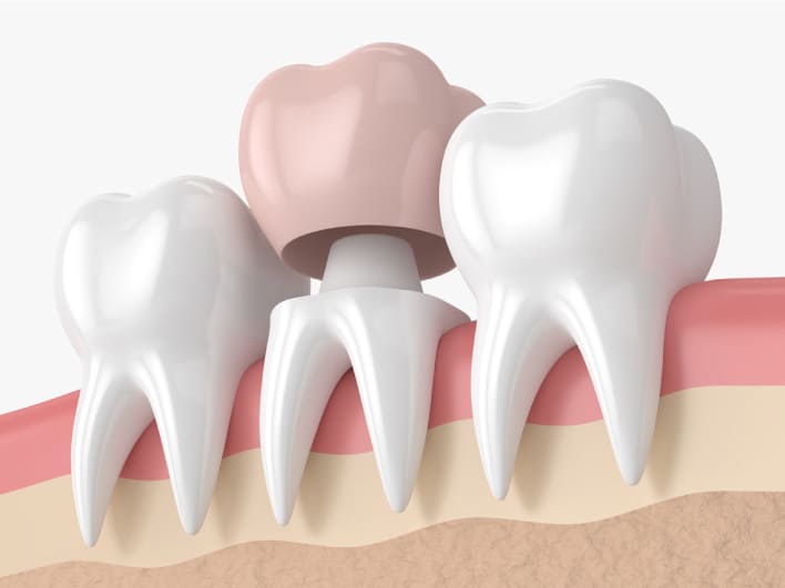 Dental crowns in Turkey