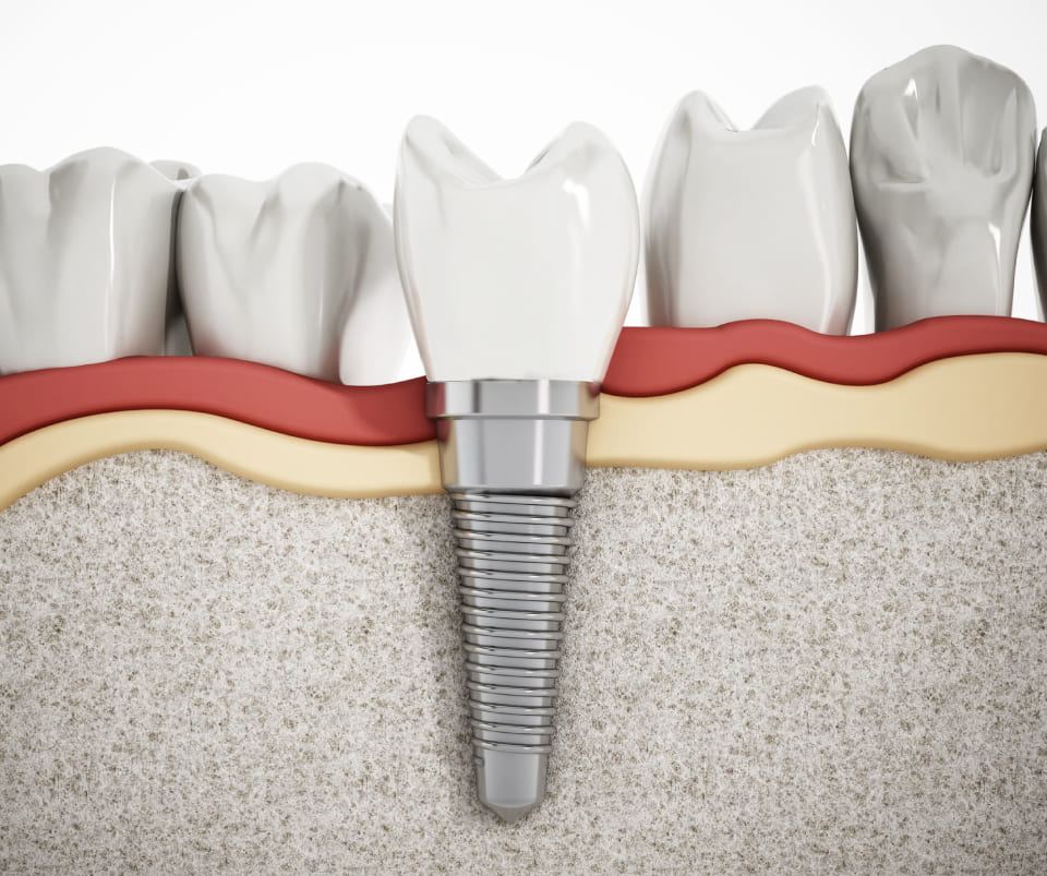 Dental crown procedure at MCAN