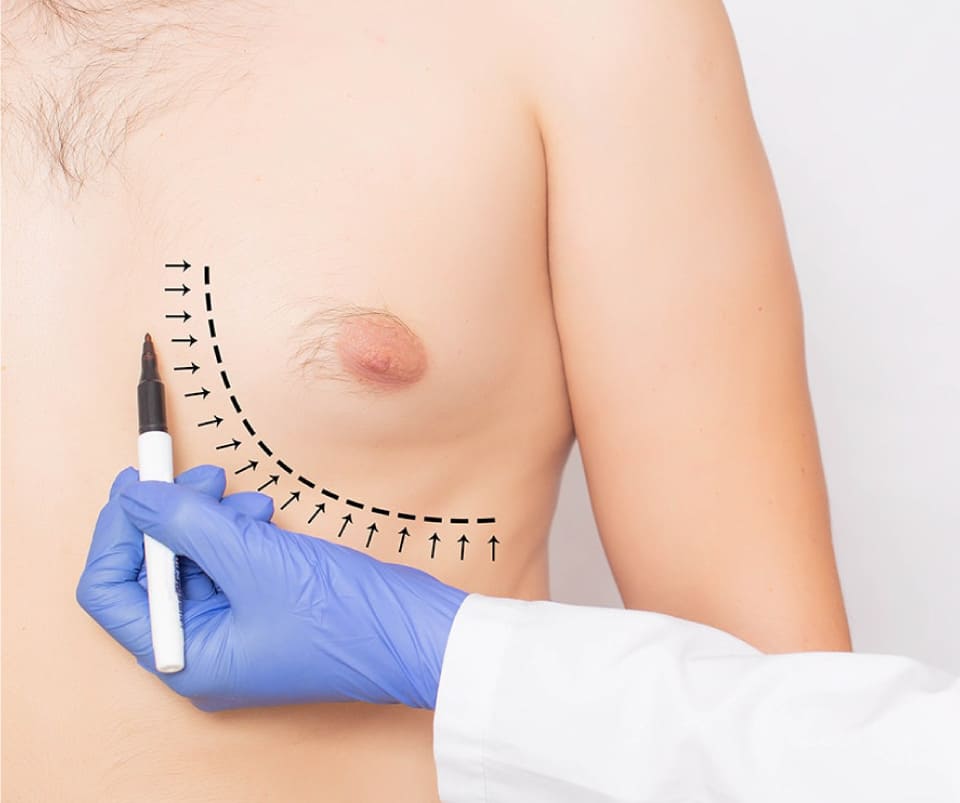 best place for gynecomastia surgery in Turkey