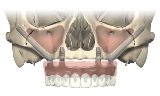 Zygomatic All on 4 dental implants