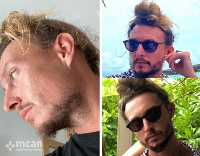 Injerto de Barba Antes y Después 1