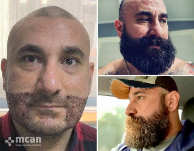 Injerto de Barba Antes y Después 2