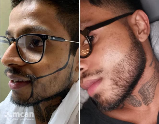 Injerto de Barba Antes y Después 3