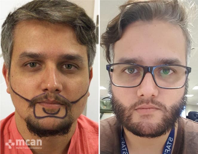 Injerto de Barba Antes y Después 4