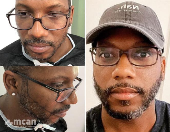 Remarkable outcomes after beard transplant Turkey