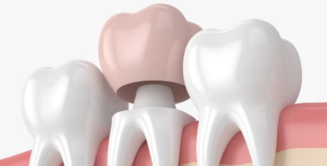 Dentalkronen (Zahnkronen)