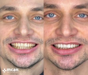 Teeth whitening in Turkey before and after 3