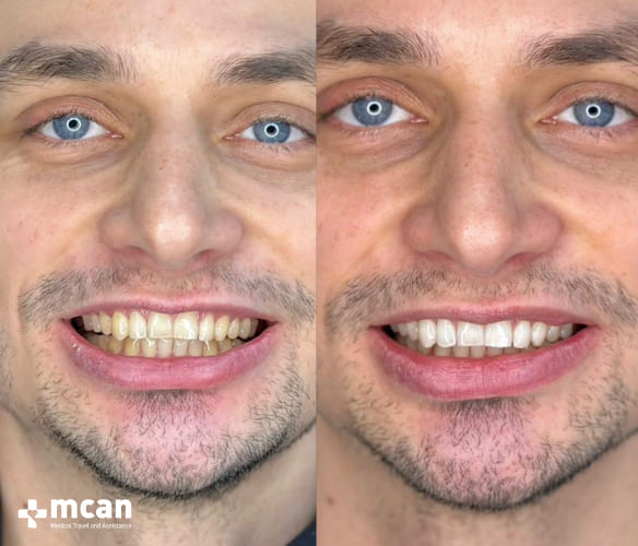 Whiter teeth through teeth-whitening turkey