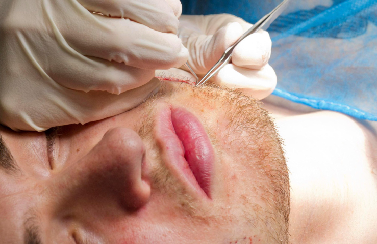 Beard transplant in Turkey