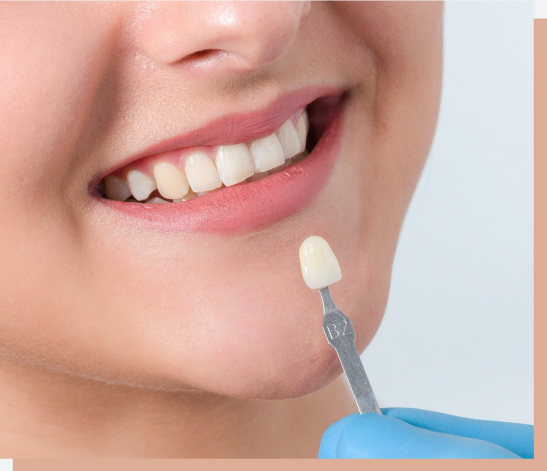 veneers achievements