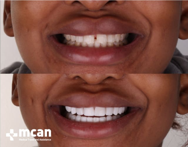 teeth veneers before and after