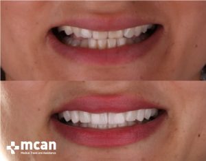 porcelain veneers 2