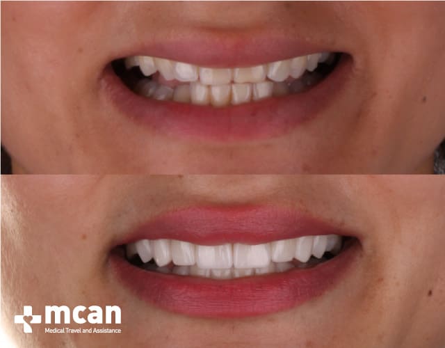 veneers turkey before and after