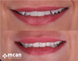 porcelain veneers 4