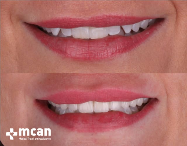 veneers turkey results