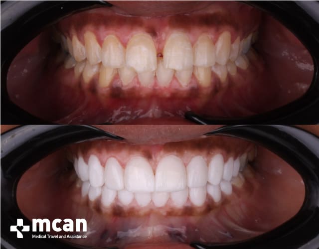 Patients’ veneers before and after