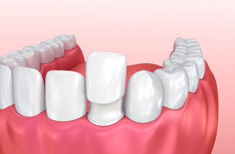step by step dental crown procedure