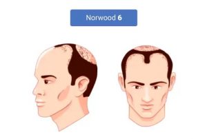 male pattern baldness stage 6 