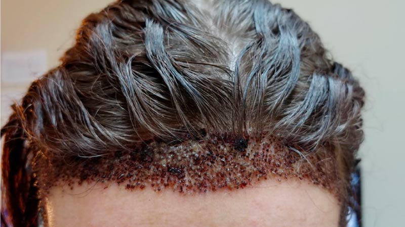 Necrosis hair transplant gone wrong 