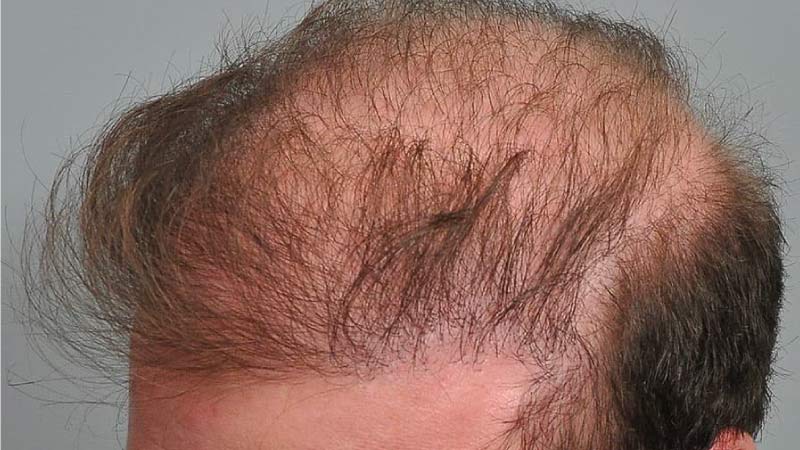 bad hair transplant