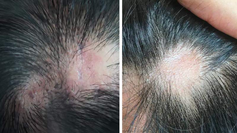 Scalp Cyst