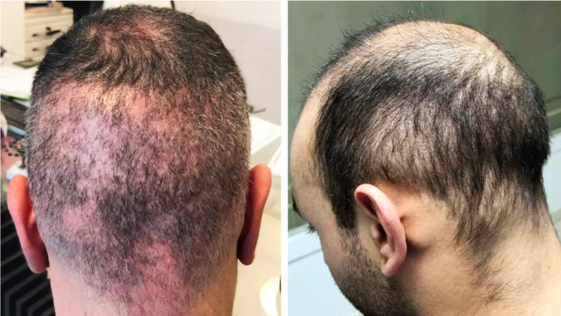 hair transplant gone wrong example