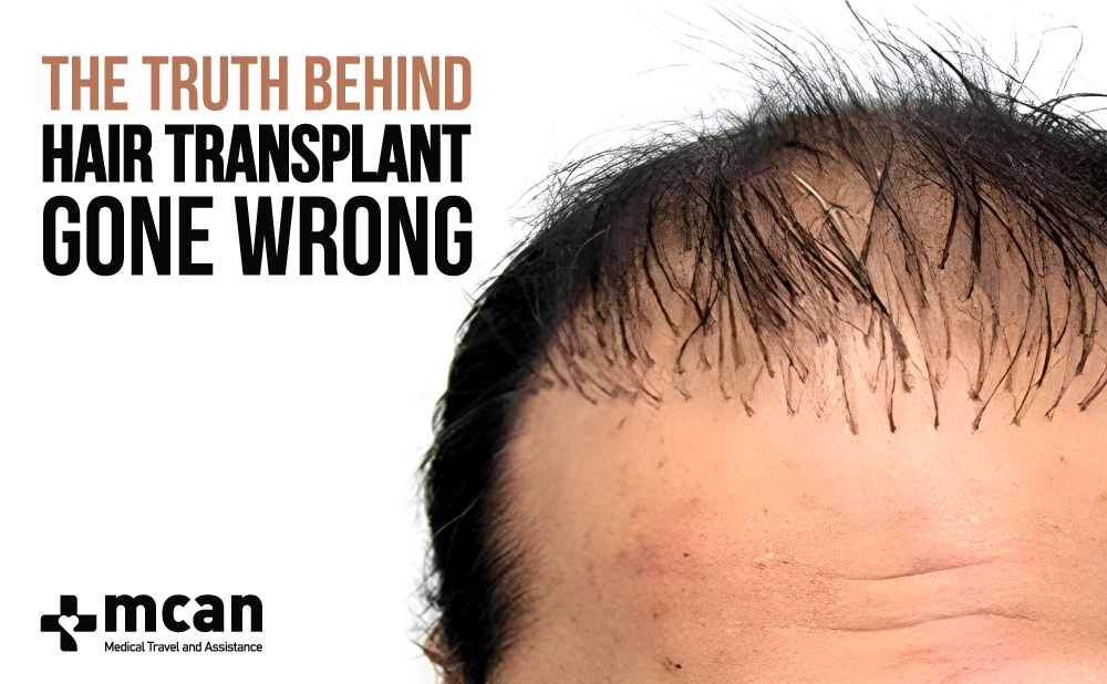 How Hair transplant gone wrong