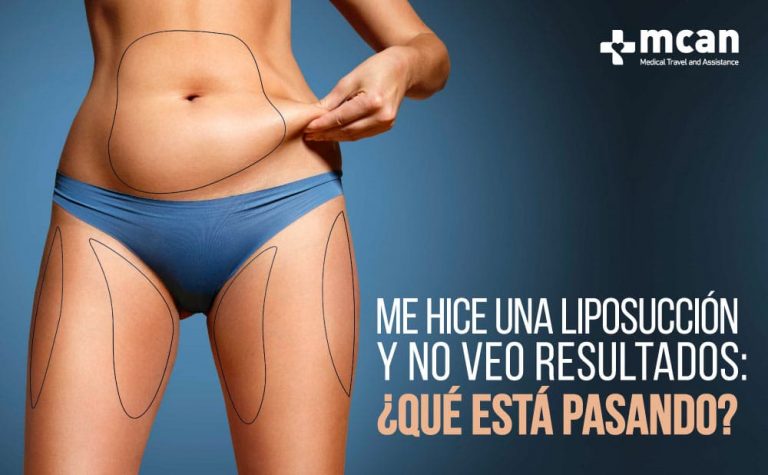 Liposucción en Turquía 81 que esta pasando web Me Hice una Liposucción y No Veo Resultados: ¿Qué Está Pasando?