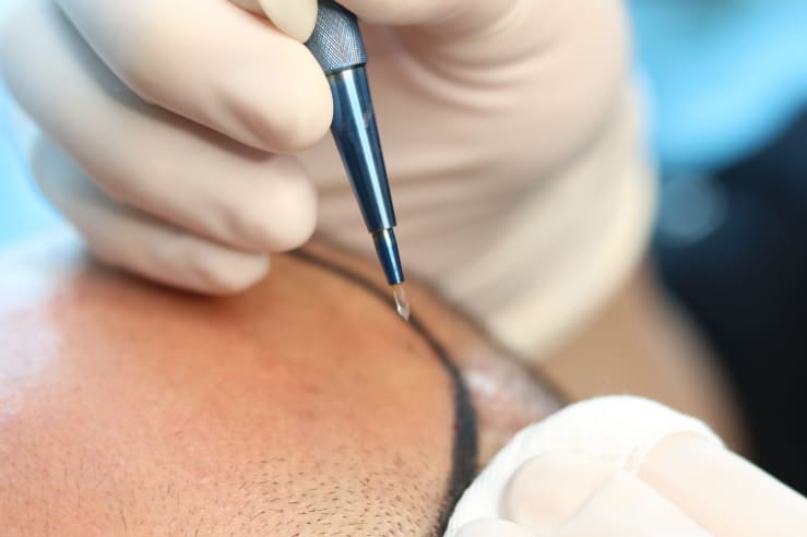 Saphir Haartransplantation Türkei 1 what is Saphirhaartransplantation