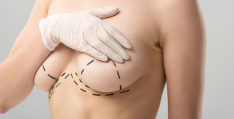 Breast Lift