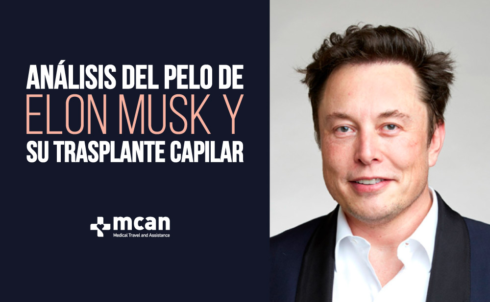 trasplante capilar Elon Musk