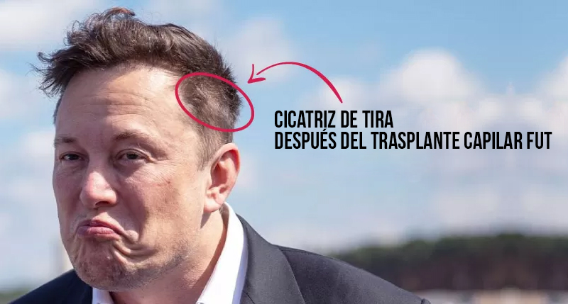 Elon Musk fut hair transplant