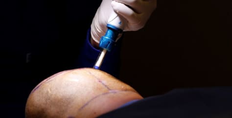 Saphir FUE Haartransplantation