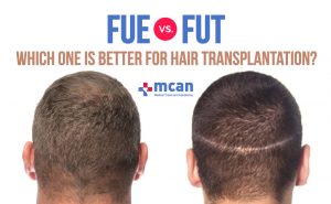 FUE vs. FUT: Which One is Better for Hair Transplantation?