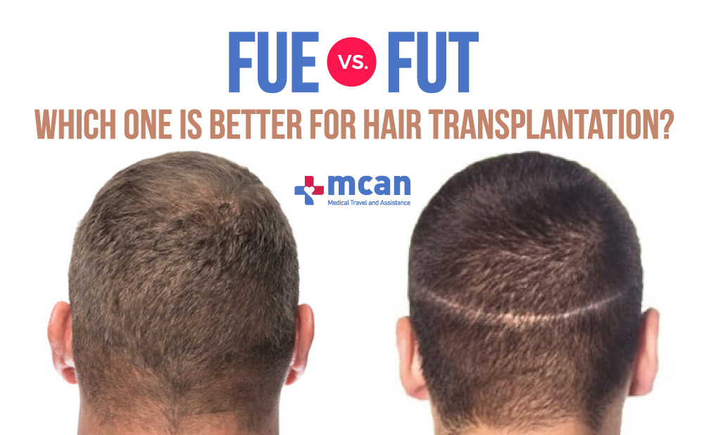 FUE vs FUT: which one is better?