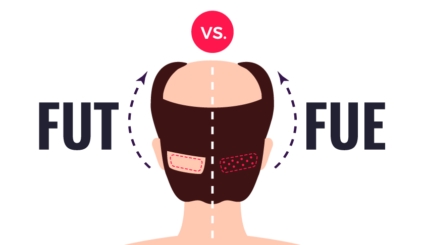 Fue vs fut hair transplant