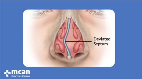 External nose job in Turkey performed by the best surgeons | MCAN Health