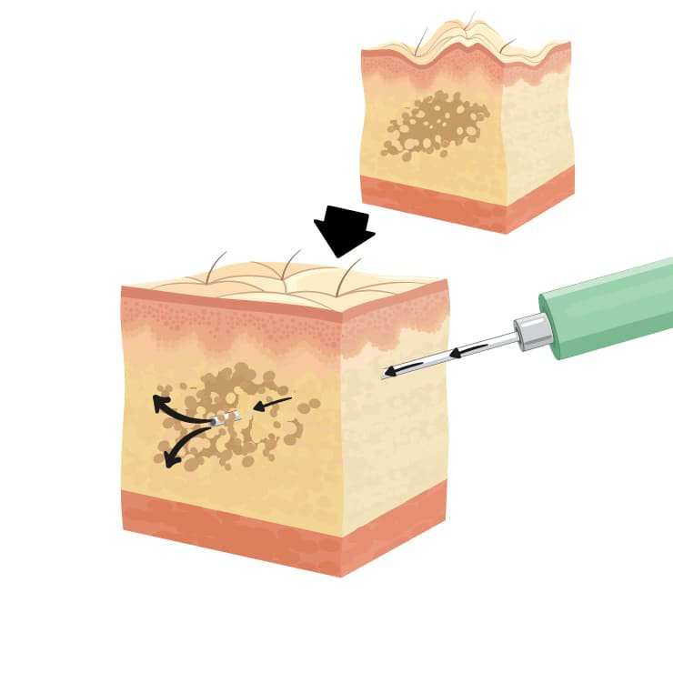 BBL procedure in Turkey