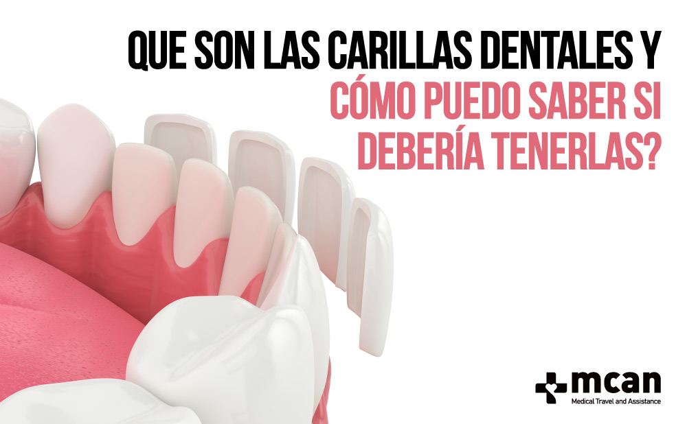 Qué carillas dentales elegir? Tipos, precios y opiniones