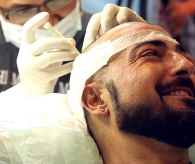 Подкожная пересадка волос в Турции 9 DHI Hair Transplant with MCAN DHI Haarimplants Türkei