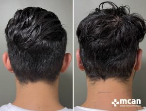 Ear Reshaping Before After 2
