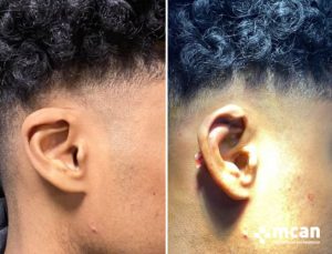 Ear Reshaping Before After 5