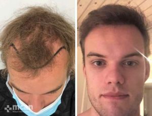 Hair Transplant in Turkey Before After 10