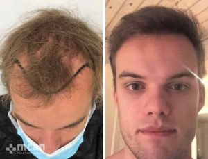 FUE Haartransplantation Vorher Nachher 7